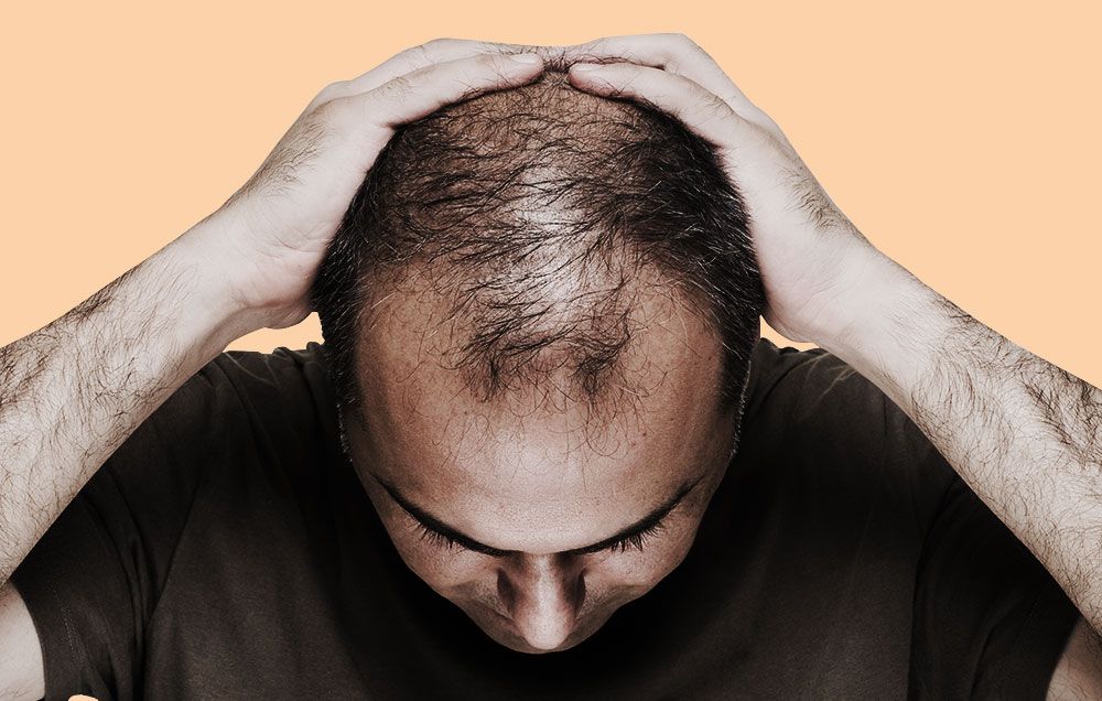 A Holistic Guide to Understanding and Combatting Hair Loss with Multivitamins